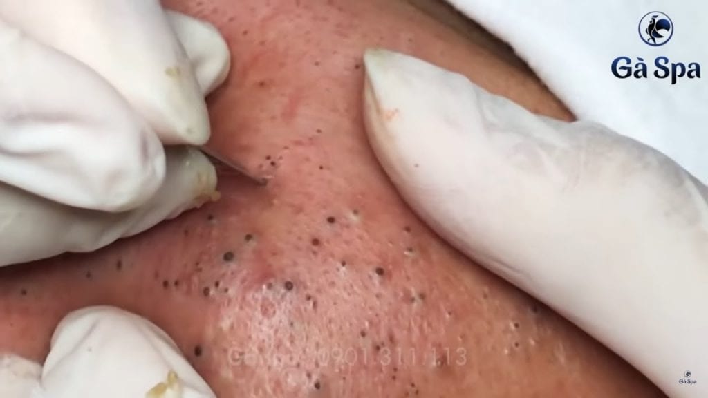 An Hour of Blackheads 2 An Hour of Blackheads 1