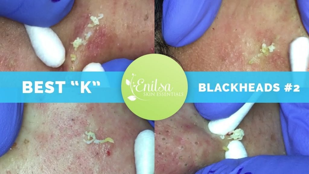 Blackhead Extraction with Qtips 1