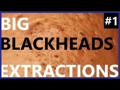 Blackheads on Happy 1