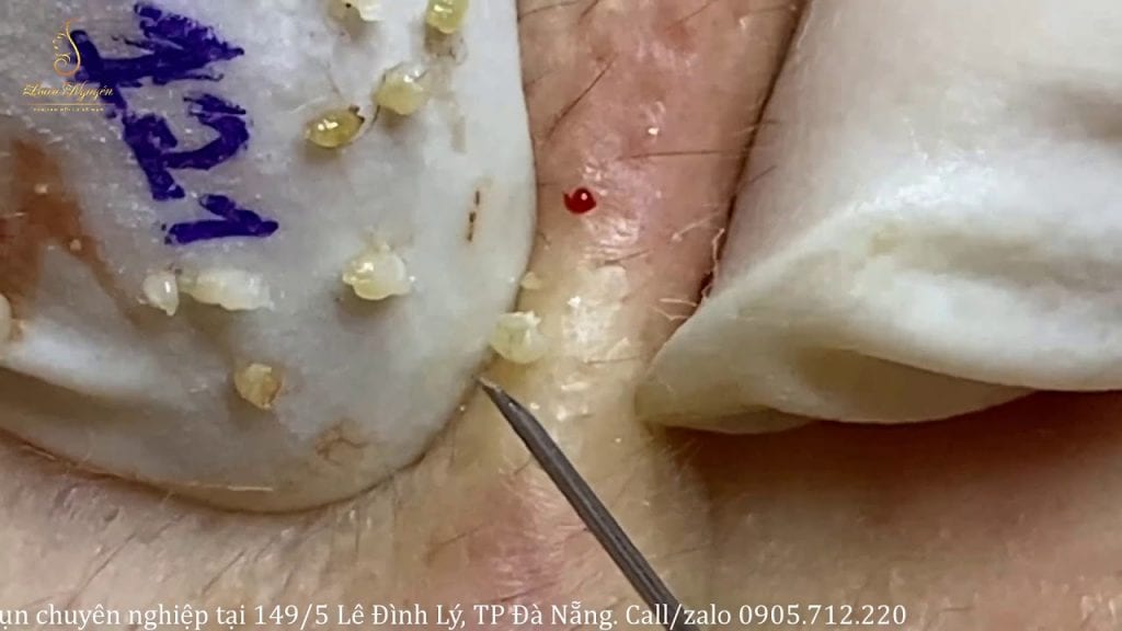 HUGE Blackheads and Pimples 1