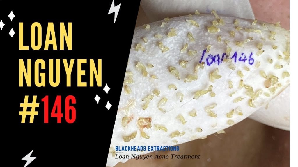 It’s Loan with Blackhead Extractions! 1