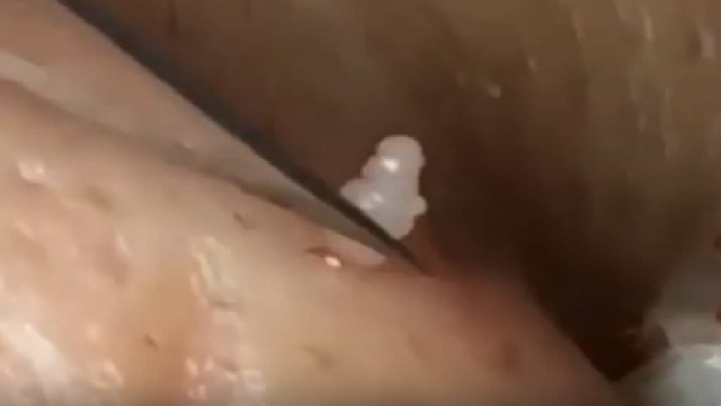 Strange Acne Treatment 1