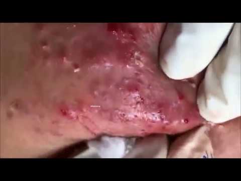 Acne and Pimple Extraction 1