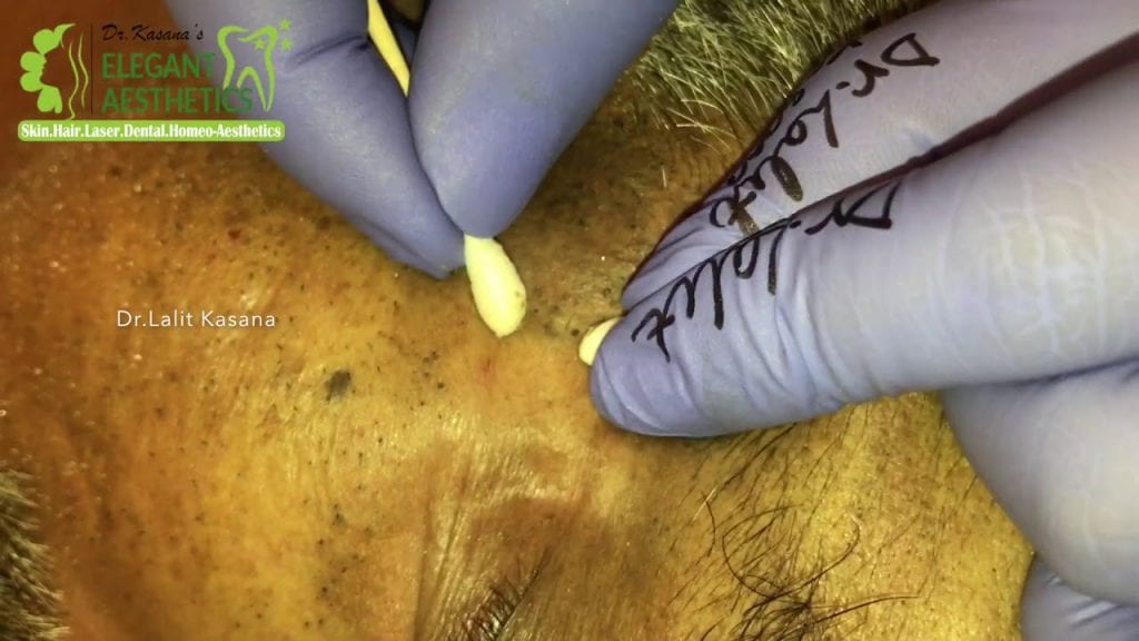 Blackhead Extraction - Dr. Lalit Kasana 1