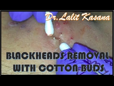 Blackheads Extracted with Cotton Buds 1