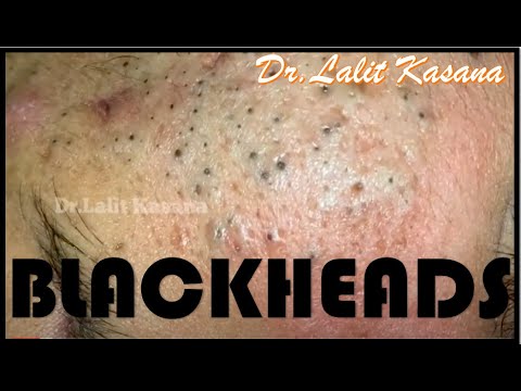Dr Lalit Kasana And Blackheads 2 Dr Lalit Kasana And Blackheads 1