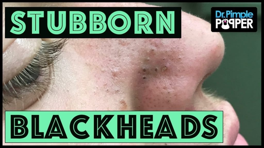 Dr Pimple Popper Returns with Blackheads 1
