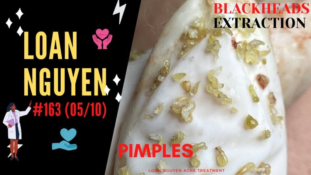 Extractions of Blackheads on the Face 2 Extractions of Blackheads on the Face 1