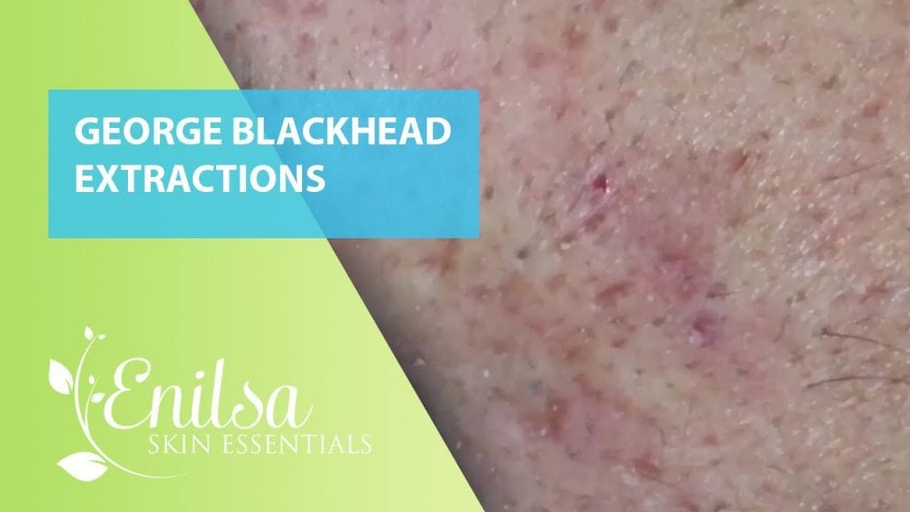 George has Blackheads 2 George has Blackheads 1