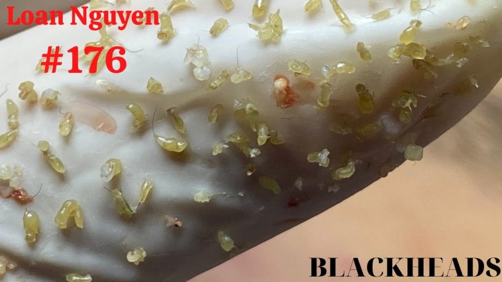 Hidden Acne Gems 2 Hidden Acne Gems 1