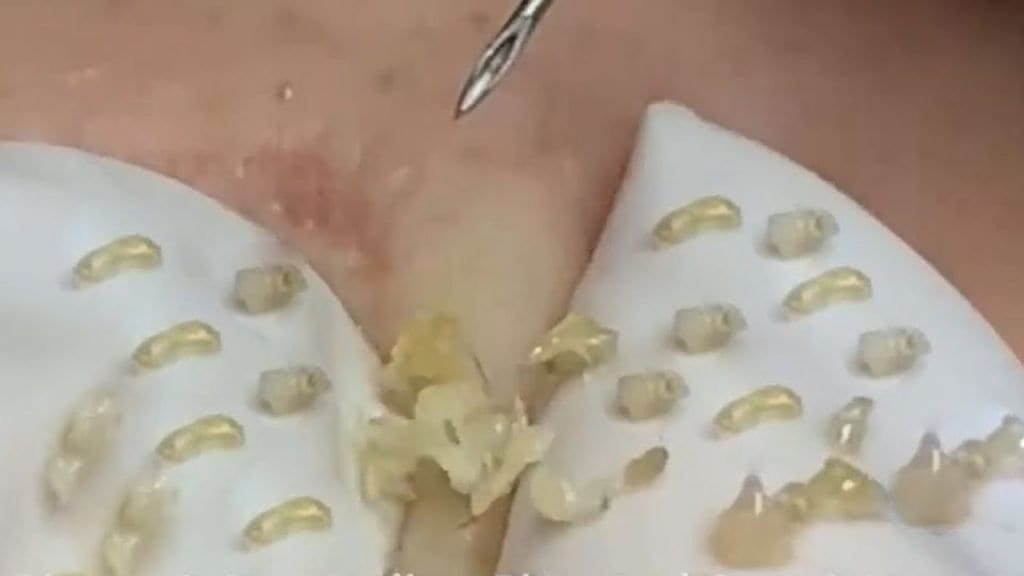 Whitehead and Blackhead Extractions 1