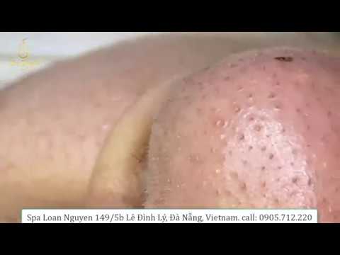Blackhead Extractions on a Girl 1