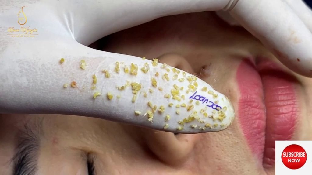 Blackheads and Whiteheads on the Face 2 Blackheads and Whiteheads on the Face 1