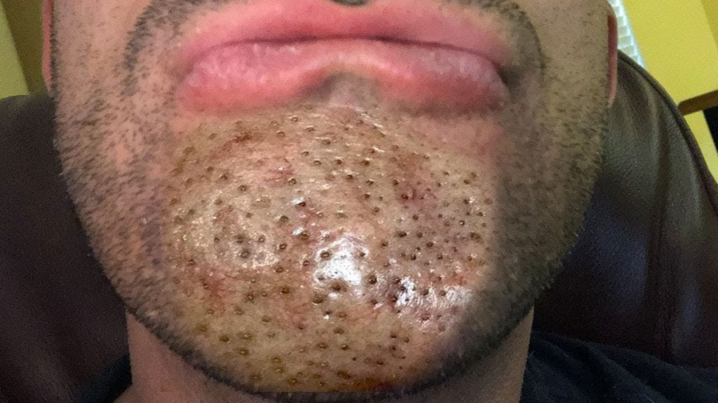 Hundreds of Blackheads 1