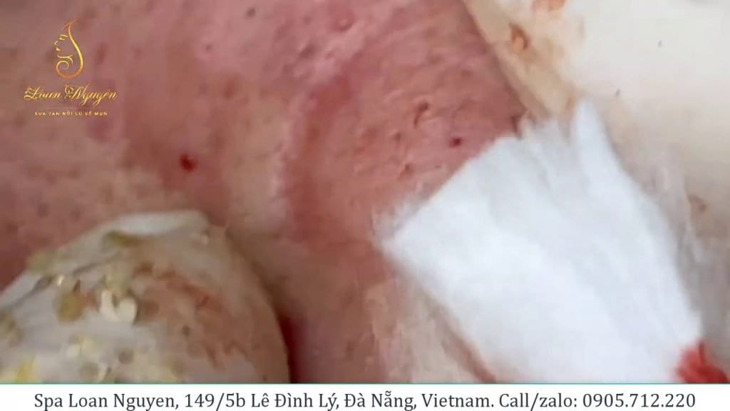 Blackhead Extractions with Loan Nguyen 1