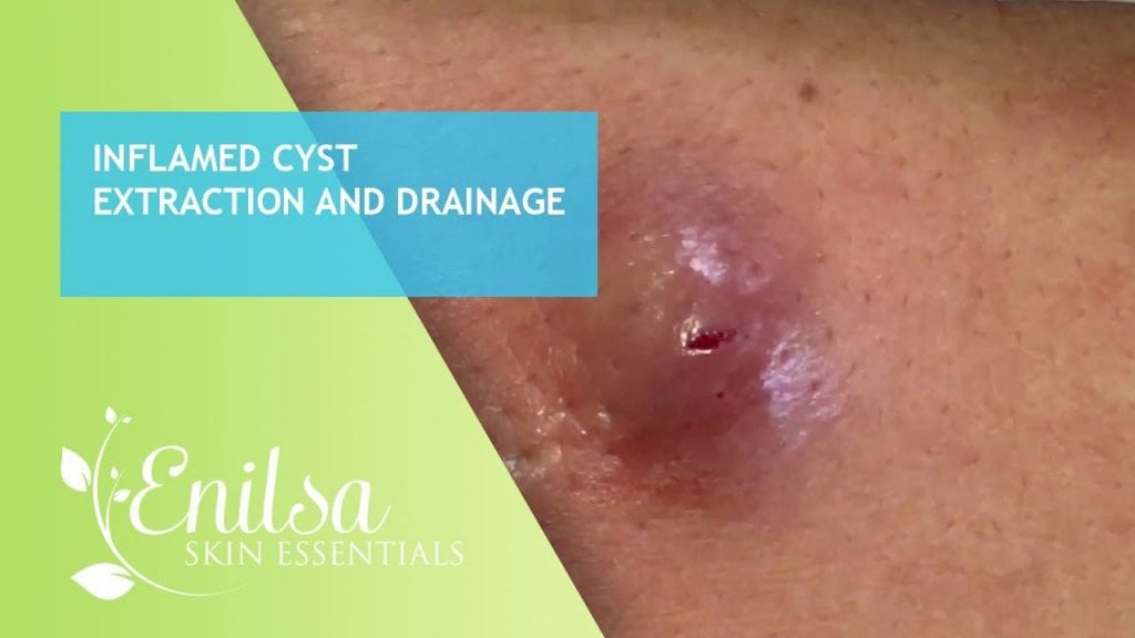 Inflamed Cyst Extractions 1