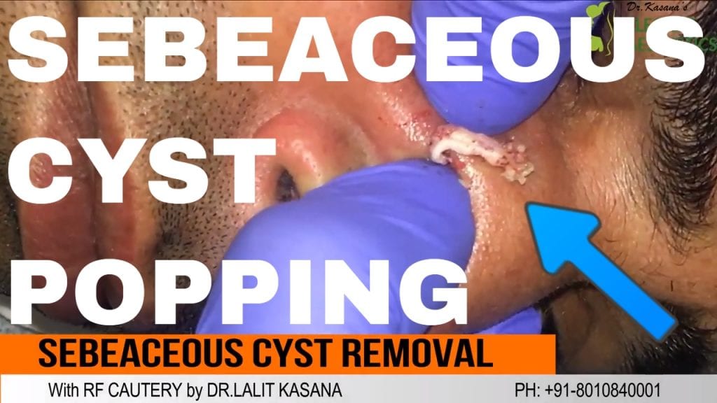 Sebaceous Cyst Removal 1