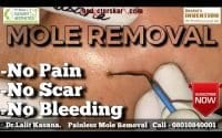 Something Different - Mole Removal 2 Something Different - Mole Removal 2