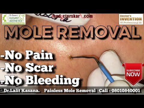 Something Different - Mole Removal 2 Something Different - Mole Removal 1