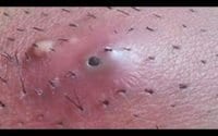 Squeezing zits and cleaning out pores 3 Squeezing zits and cleaning out pores 3