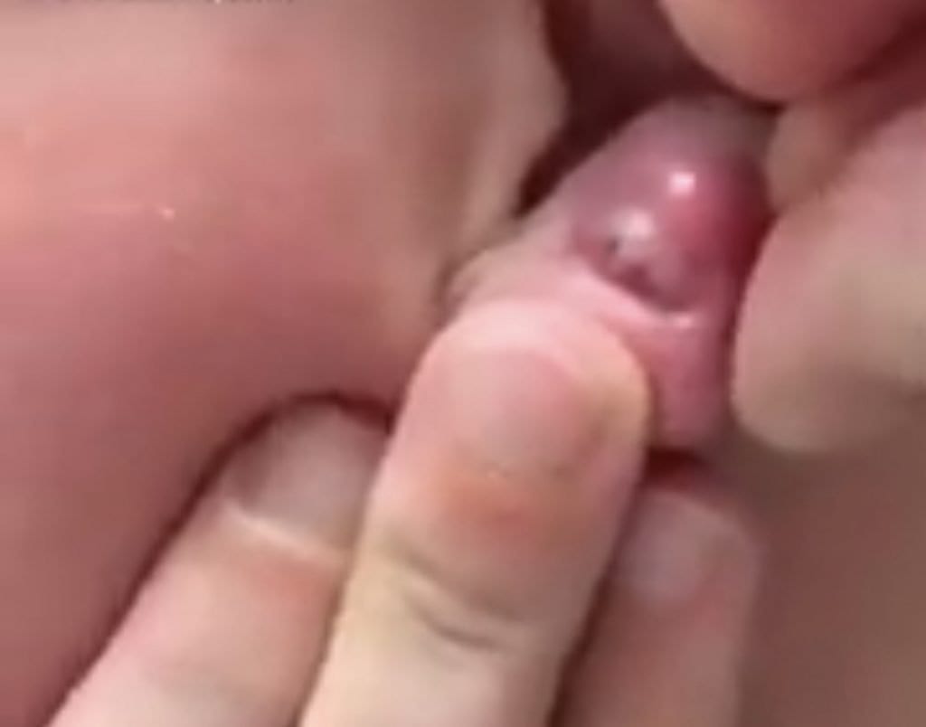 Ear Zit Pop 1 Ear Zit Pop 1