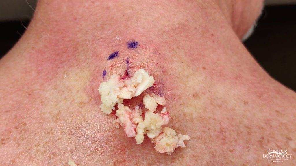 A Classic Cyst Squeeze 1