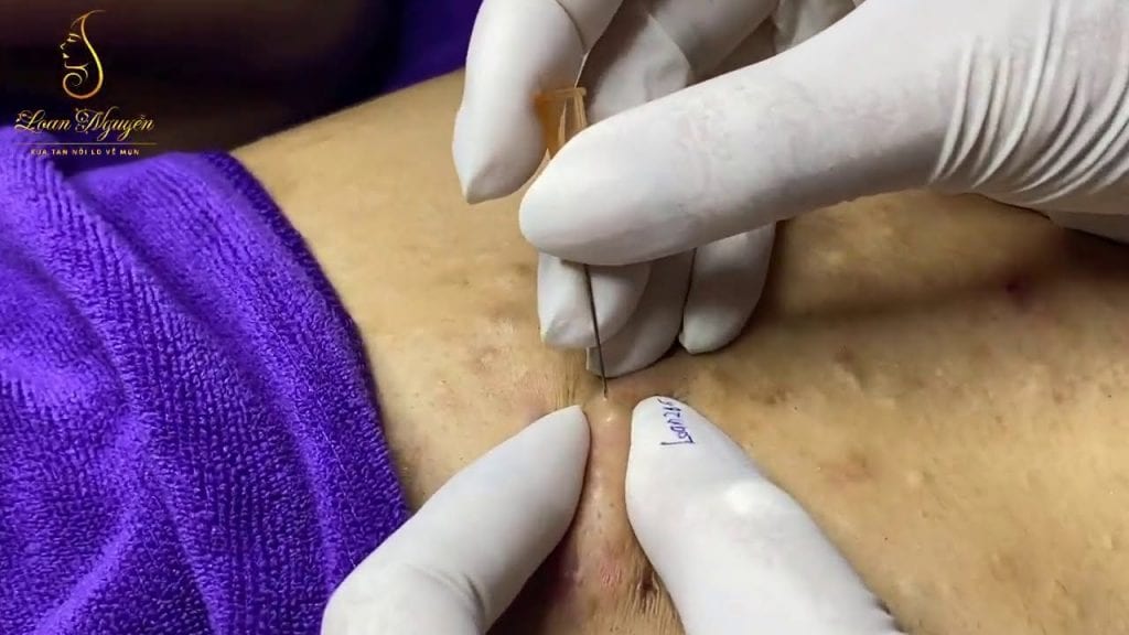 Abdomen Pimples 1