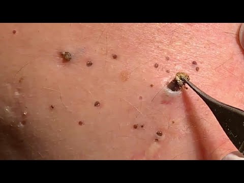 Blackhead plugs removed 1