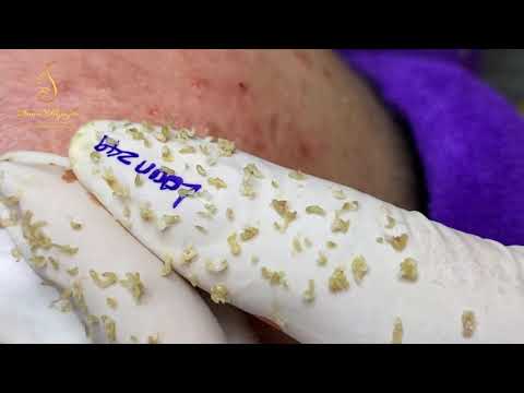 Blackheads across the face 1