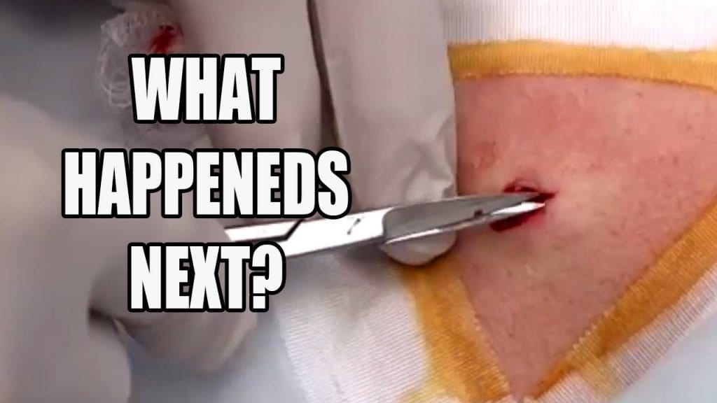 Cheeky Cyst Extraction 1