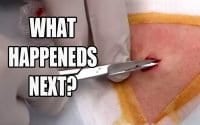 Cheeky Cyst Extraction 3