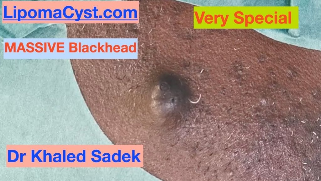 The King of all Blackheads! 1