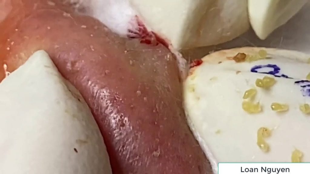 Weekend Blackheads with Loan Nguyen 1