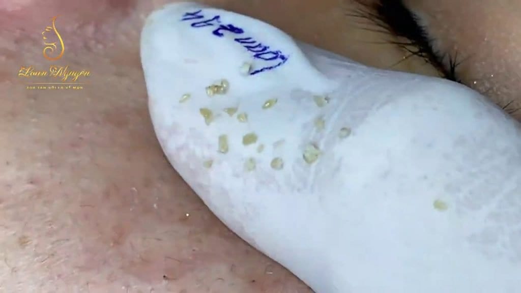 Acne and Blackhead Extractions 1