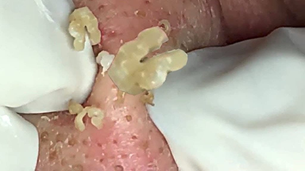 Acne removal 1