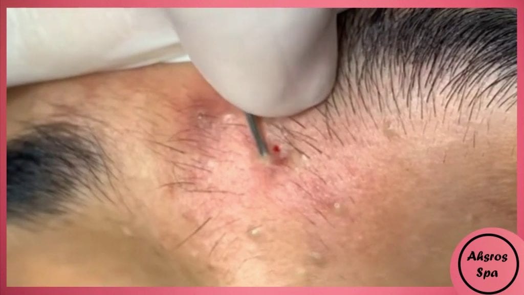 Best Pimple Popping compilation of August 2020 1