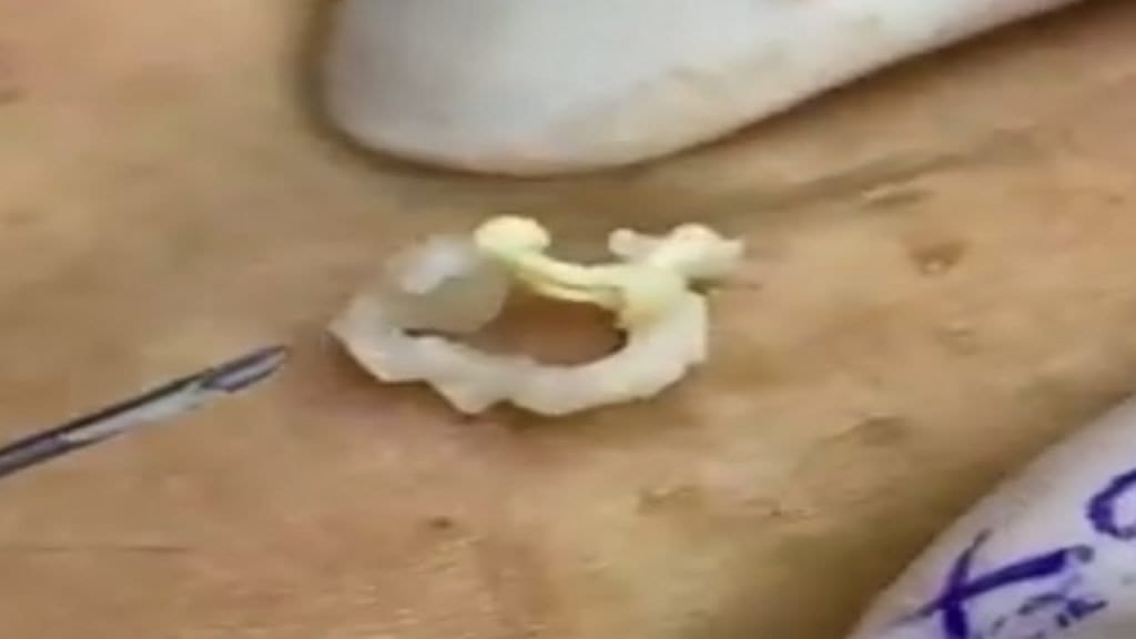 Blackheads and Cysts 1