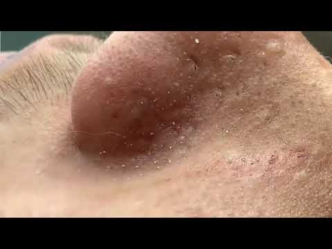 Blackheads Nose Extractions | Pimple Popper Blackheads 1