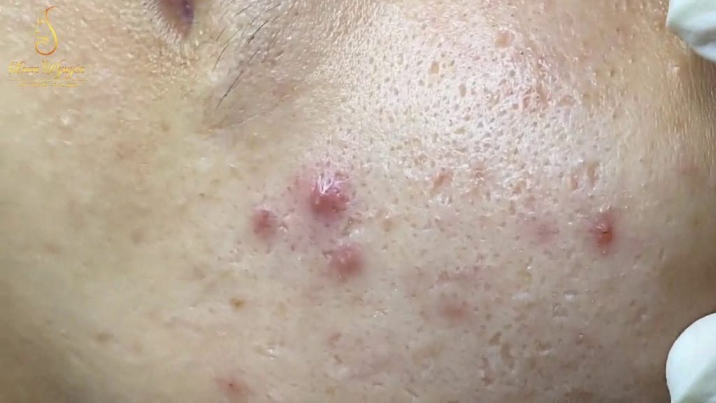 Blackheads Treatment 1