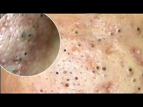 Compilation of Blackheads 1