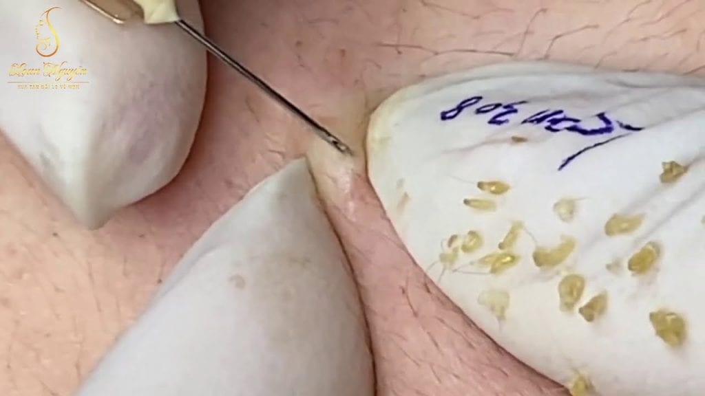 Forever Blackheads 1