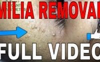 Milia Removal by Dr.Lalit Kasana 1 Milia Removal by Dr.Lalit Kasana 1
