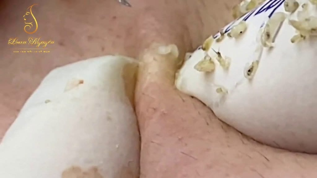 Music and Blackhead Extractions 2 Music and Blackhead Extractions 1