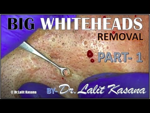 Whiteheads Removal 1