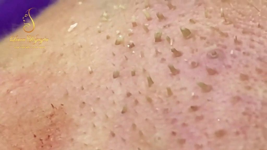 Amazing Blackheads with Loan 1