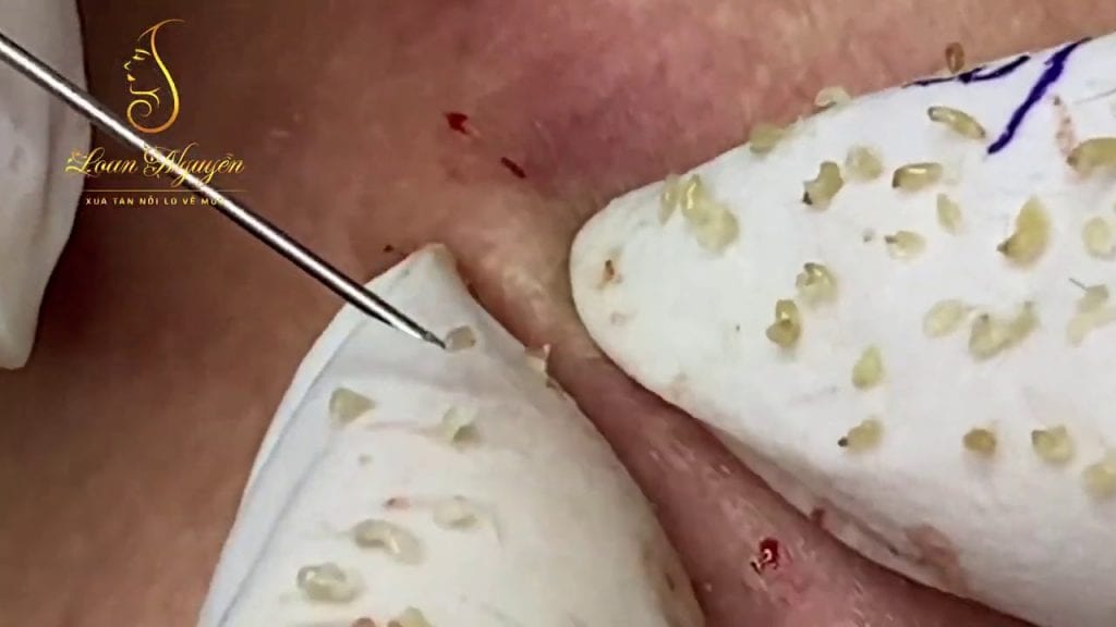 Blackheads, baby! 2 Blackheads, baby! 1