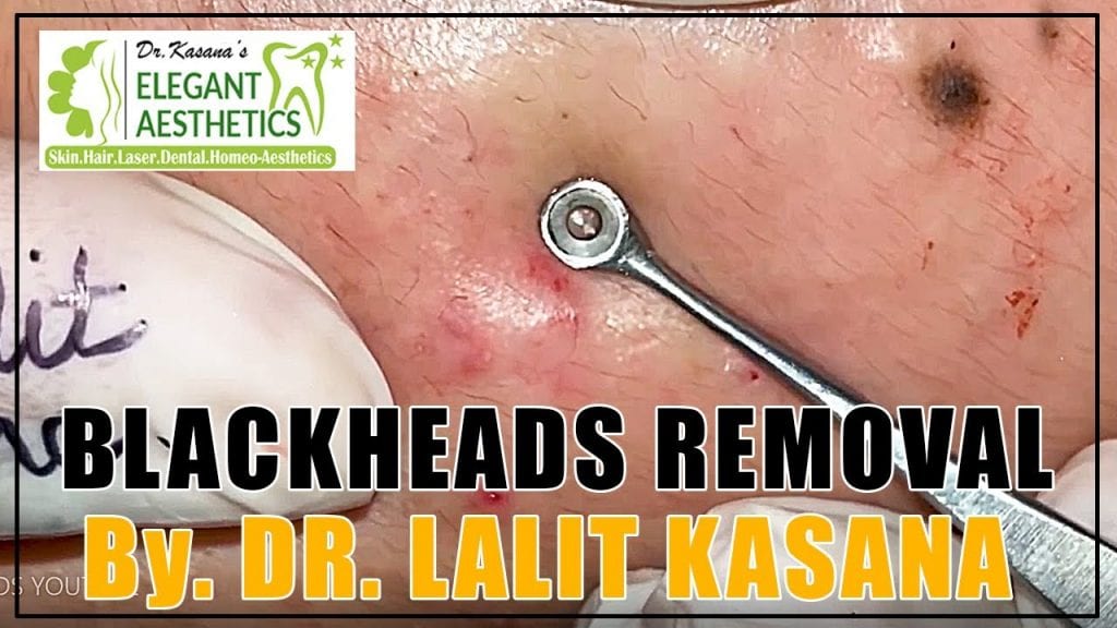 Blackheads with Dr Lalit Kasana 2 Blackheads with Dr Lalit Kasana 1