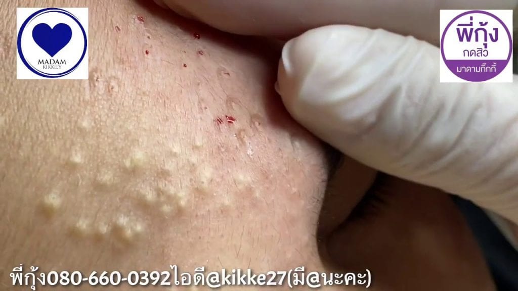 Bumpy Skin 2 Bumpy Skin 1