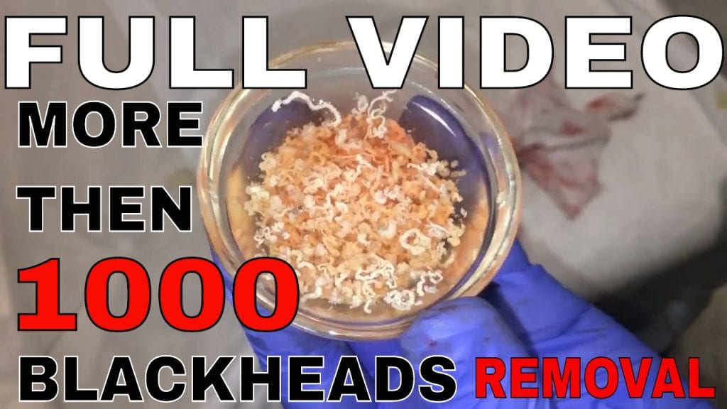 Comedones Removal 2 Comedones Removal 1