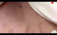 Mini Pimple Pops 2